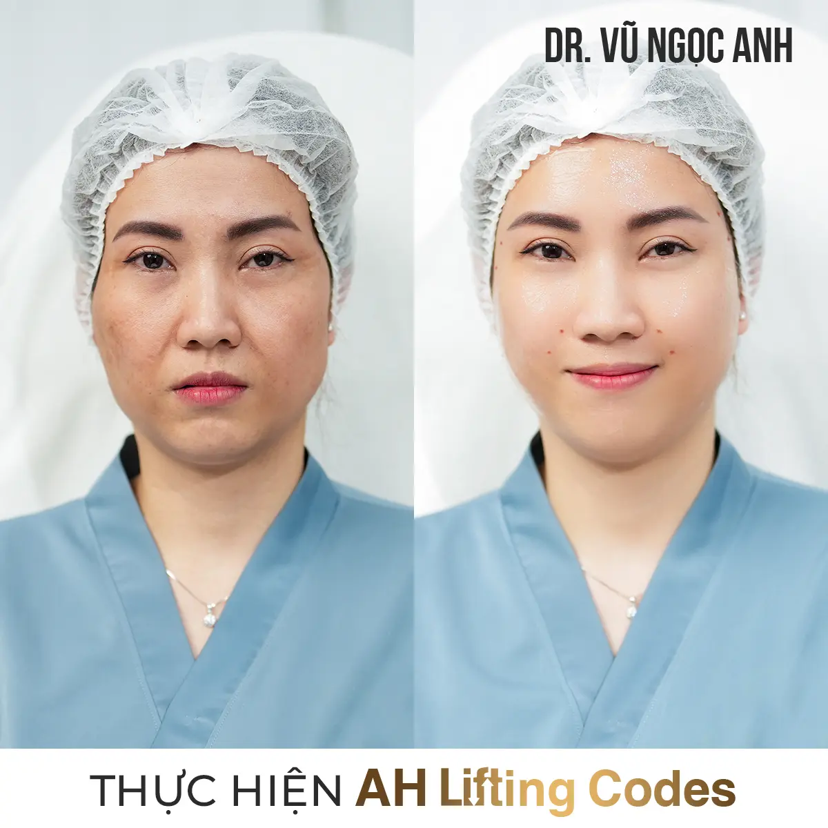 khách hàng sau khi thực hiện liệu trình AH Lifting Codes 4