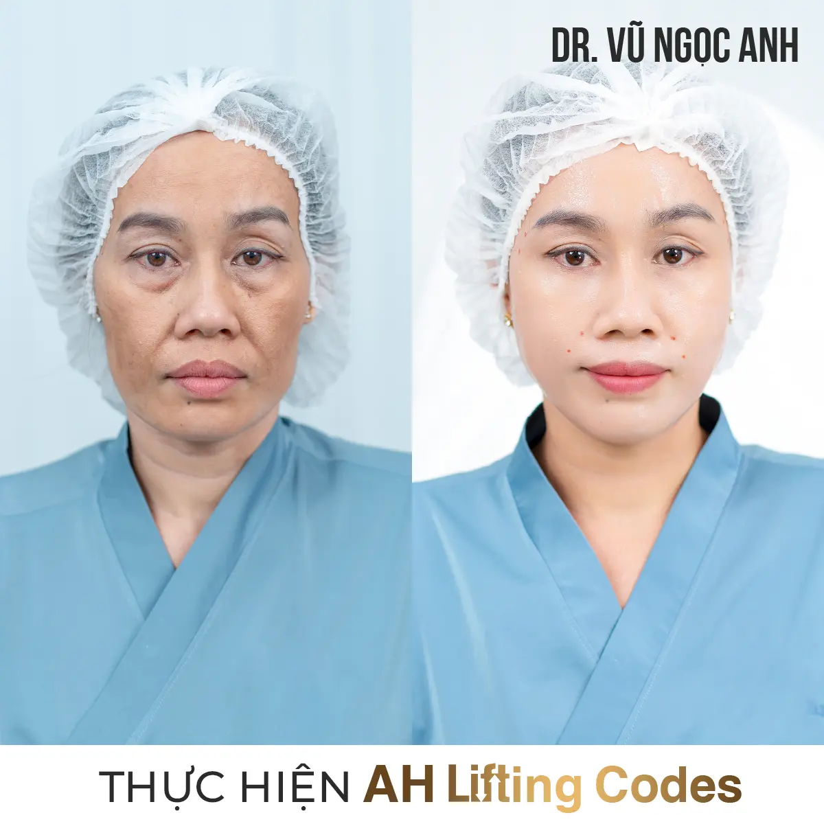 khách hàng sau khi thực hiện liệu trình AH Lifting Codes 6