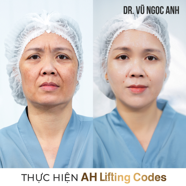 khách hàng sau khi thực hiện liệu trình AH Lifting Codes 1