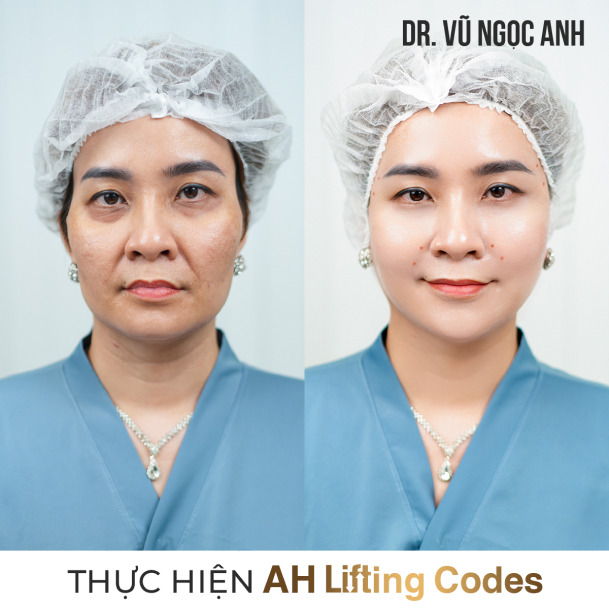 khách hàng sau khi thực hiện liệu trình AH Lifting Codes 2