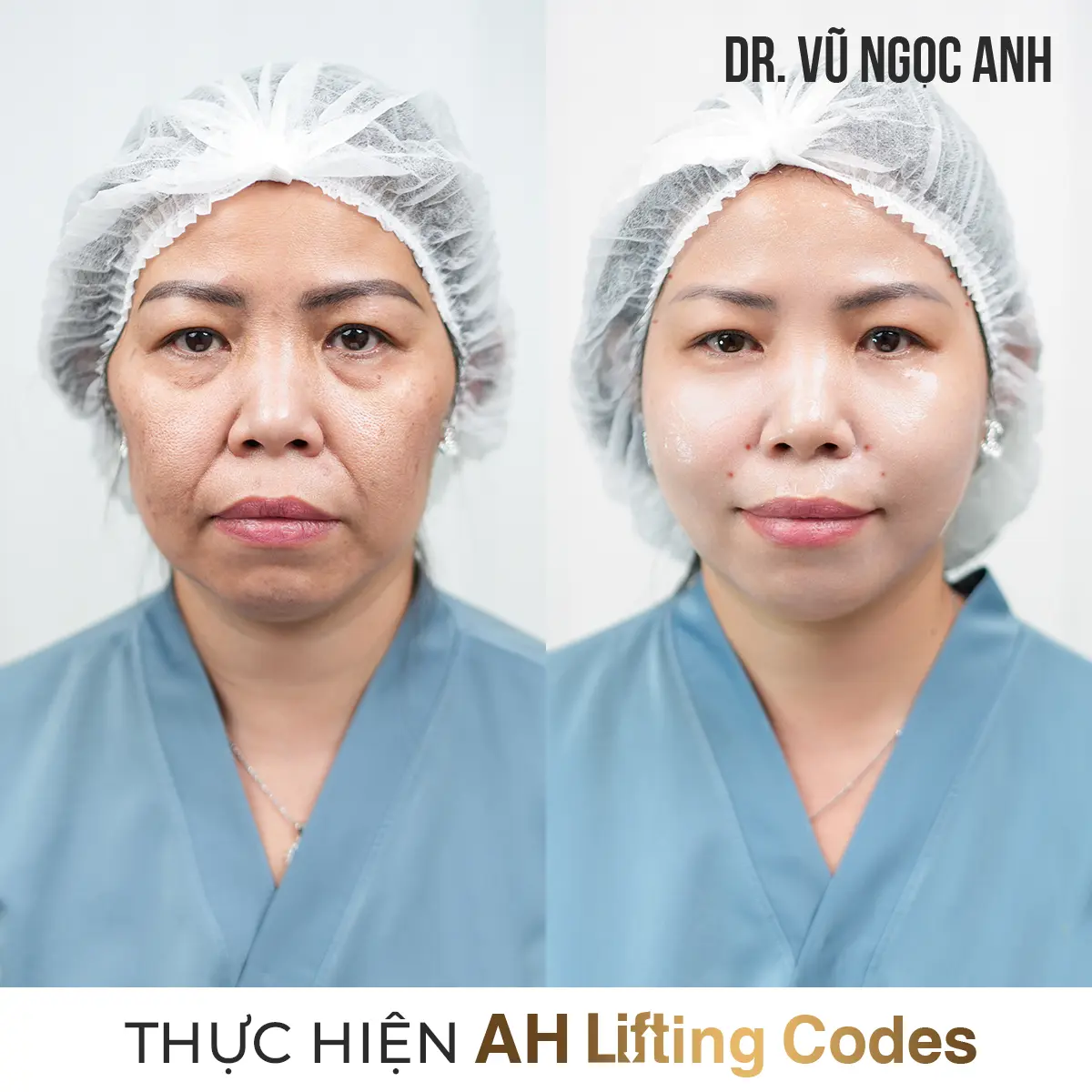 khách hàng sau khi thực hiện liệu trình AH Lifting Codes 5