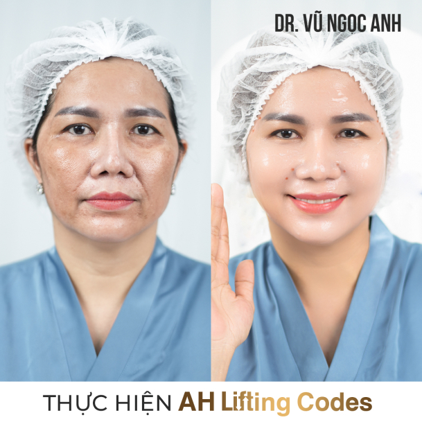 khách hàng sau khi thực hiện liệu trình AH Lifting Codes 3