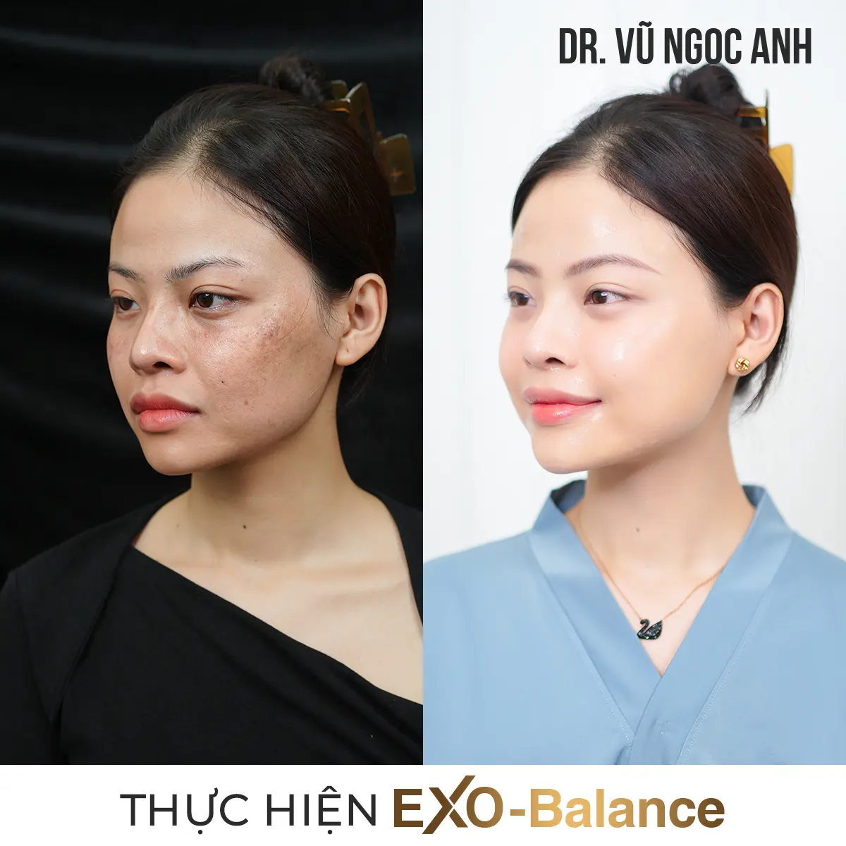 khách hàng sau khi thực hiện liệu trình Điều Trị Nám EXO - Balance 1