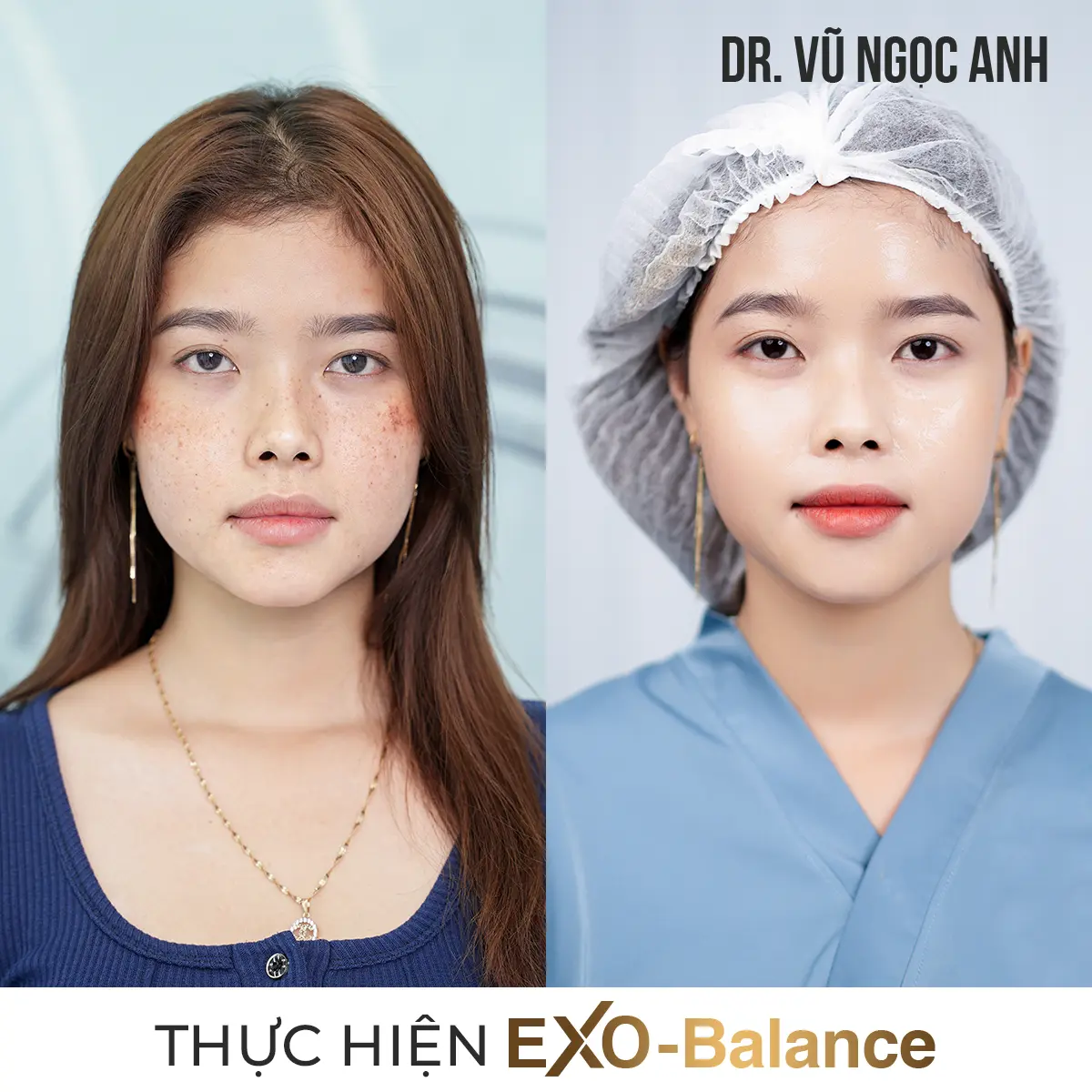 khách hàng sau khi thực hiện liệu trình Điều Trị Nám EXO - Balance 2