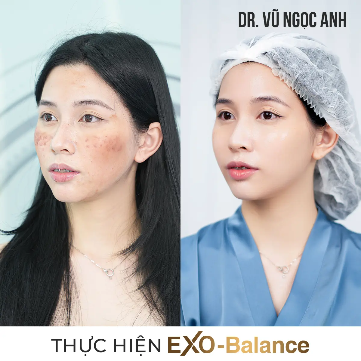 khách hàng sau khi thực hiện liệu trình Điều Trị Nám EXO - Balance 3