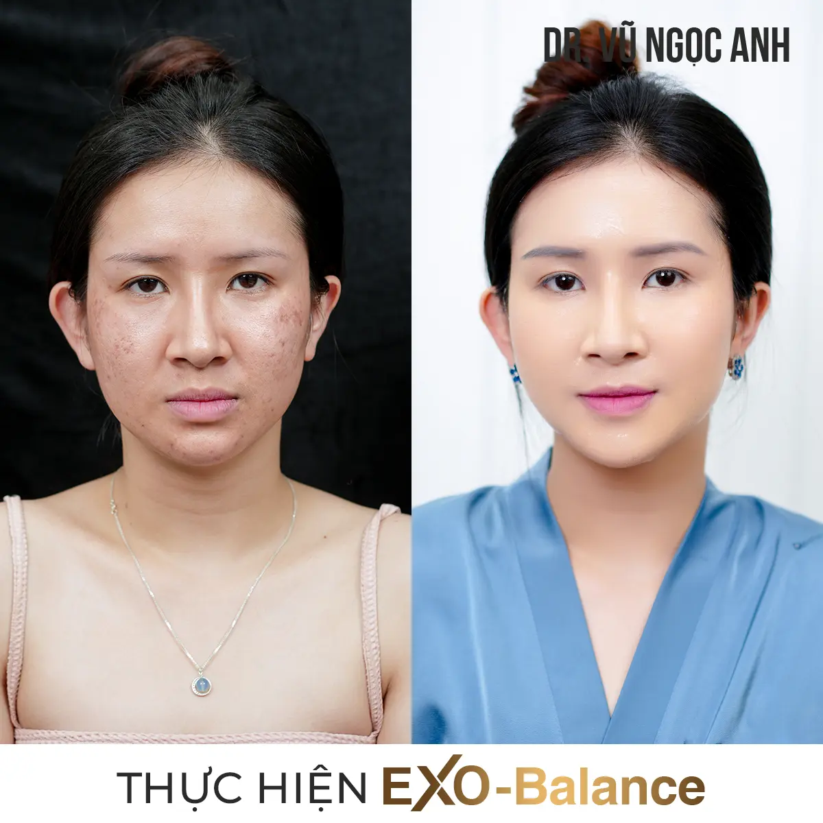 khách hàng sau khi thực hiện liệu trình Điều Trị Nám EXO - Balance 4