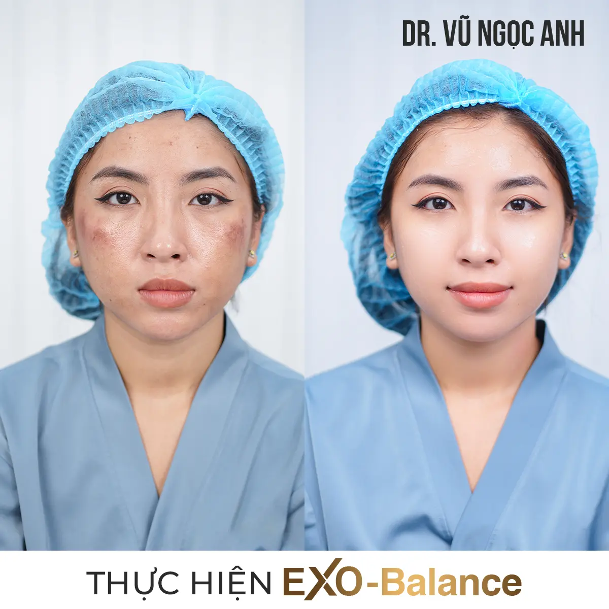 khách hàng sau khi thực hiện liệu trình Điều Trị Nám EXO - Balance 5