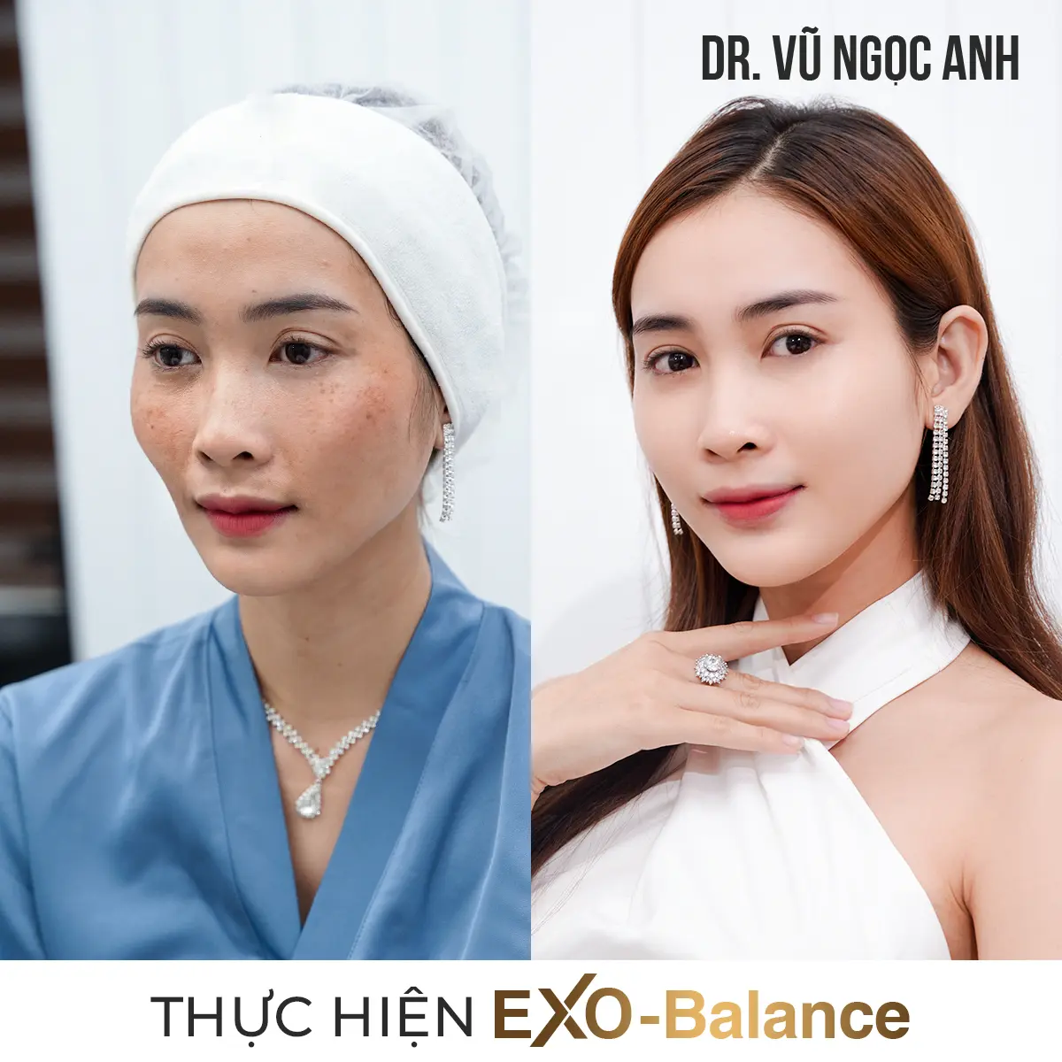 khách hàng sau khi thực hiện liệu trình Điều Trị Nám EXO - Balance 6