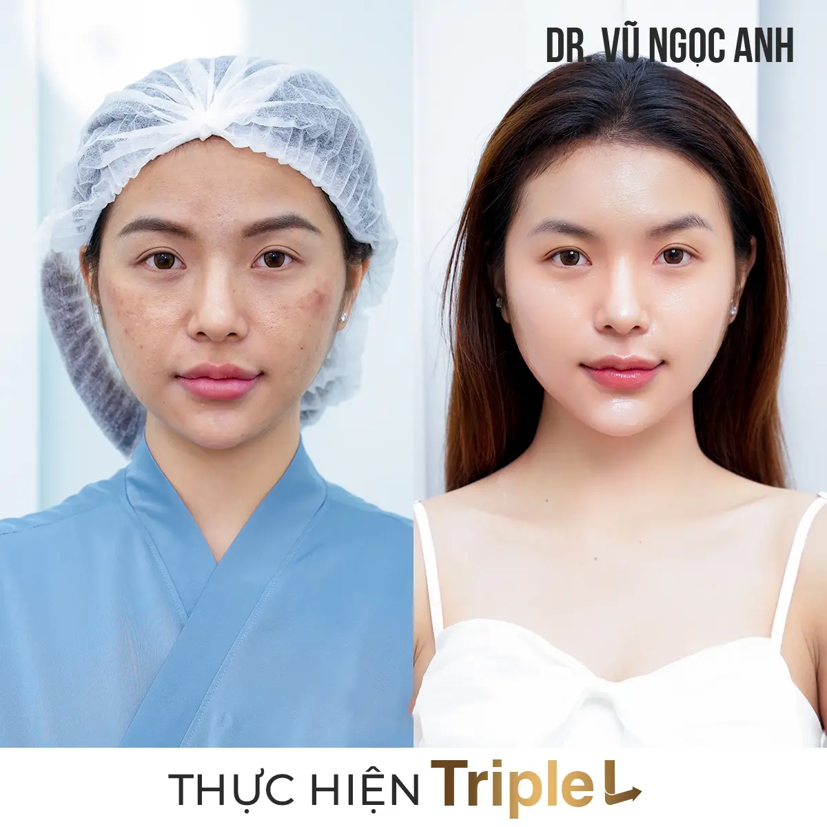 khách hàng sau khi thực hiện liệu trình Căng bóng da Triple L 5