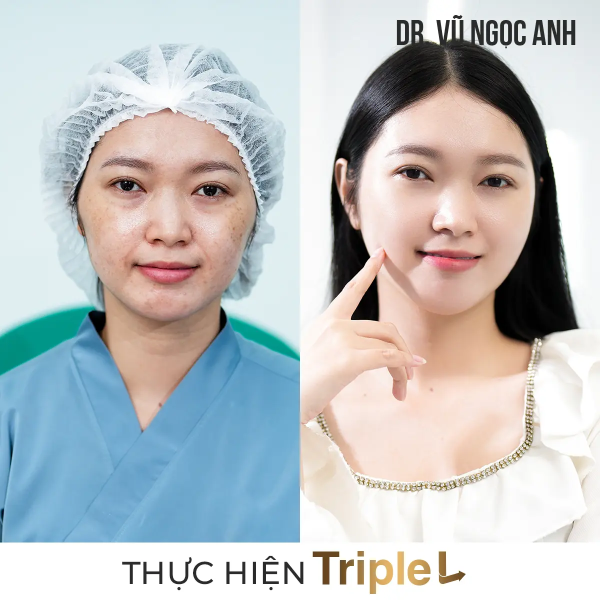 khách hàng sau khi thực hiện liệu trình Căng bóng da Triple L 1