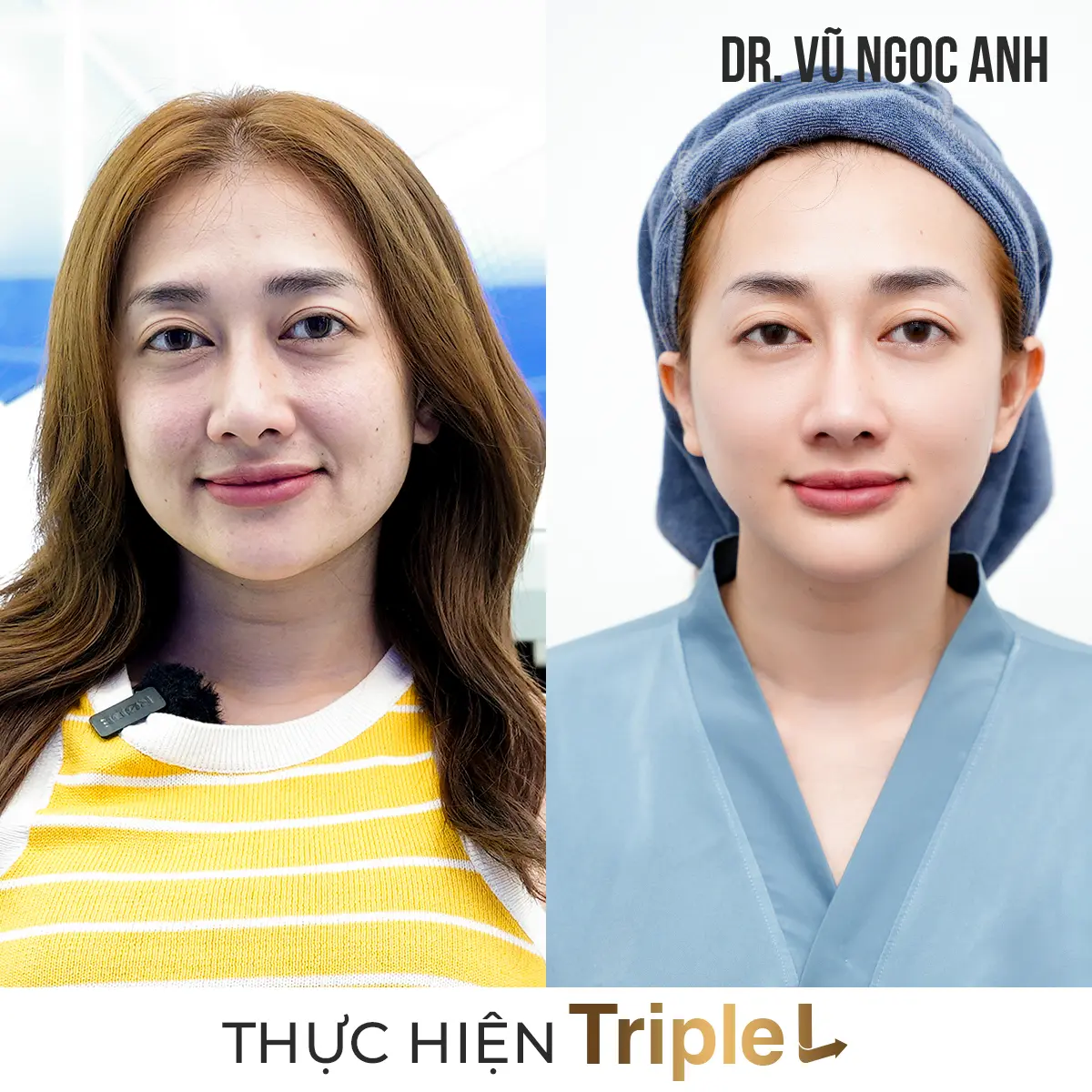 khách hàng sau khi thực hiện liệu trình Căng bóng da Triple L 4