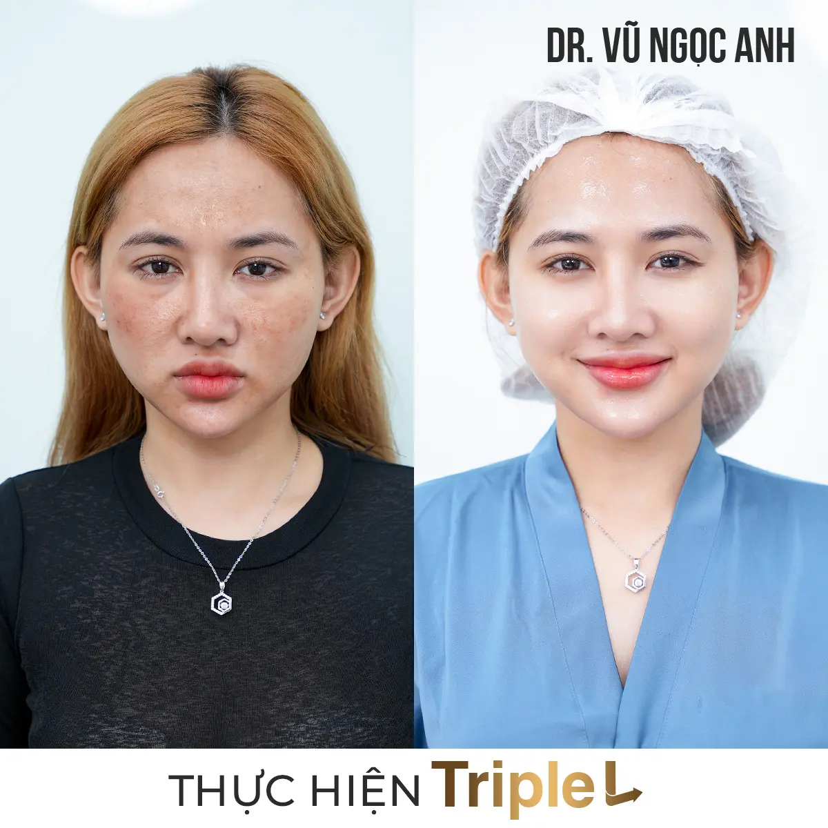 khách hàng sau khi thực hiện liệu trình Căng bóng da Triple L 6