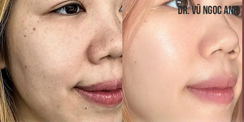 khách hàng tiêm căng bóng da mặt tại Dr. Vũ Ngọc Anh 2