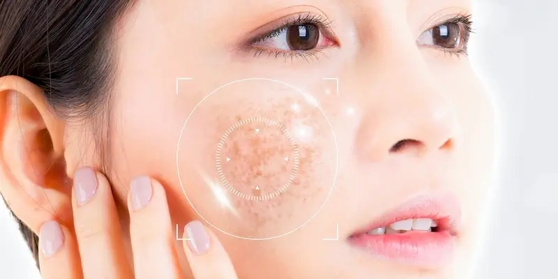 Cách điều trị nám mảng và bảng giá dịch vụ mới nhất hiện nay 1 Cách điều trị nám mảng và bảng giá dịch vụ điều trị nám