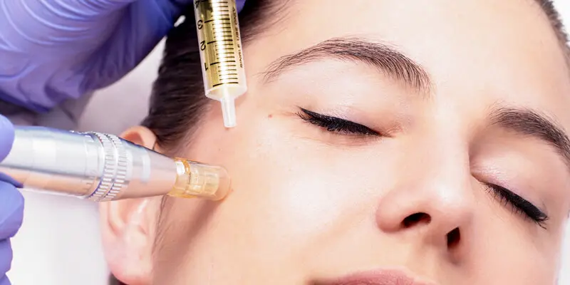 Cách điều trị nám mảng và bảng giá dịch vụ mới nhất hiện nay 5 Tiêm tinh chất Meso trị nám (Mesotherapy)