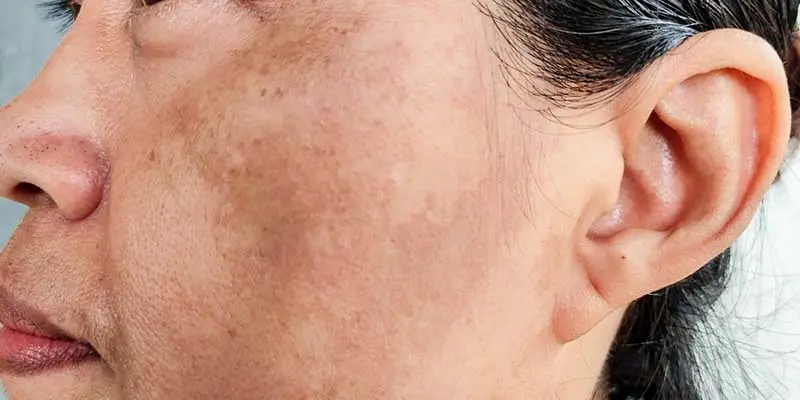 Cách điều trị nám mảng và bảng giá dịch vụ mới nhất hiện nay 2 Nám mảng là gì?