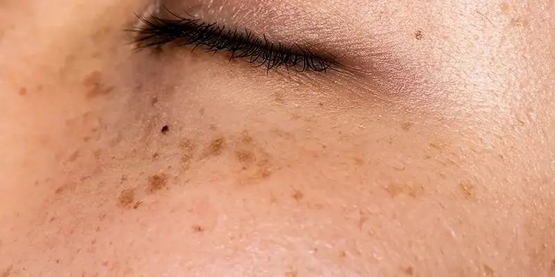 Các phương pháp điều trị nám chân sâu mới nhất hiện nay 2 Nám chân sâu là gì?