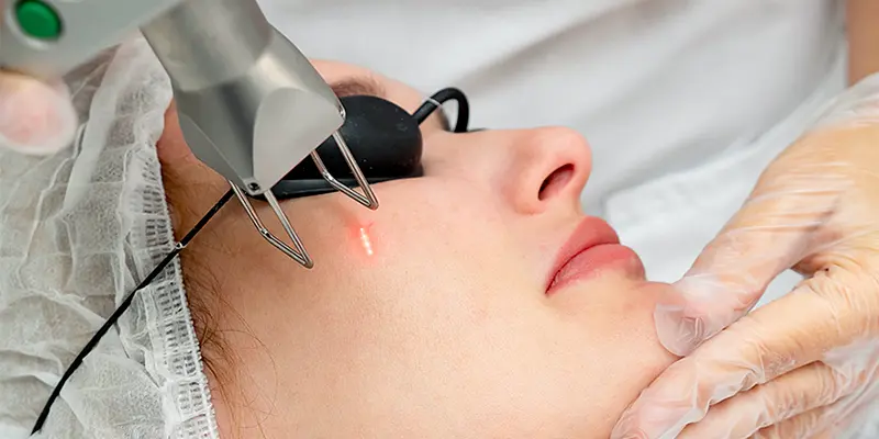 Mách bạn 10 cách trị nám da mặt lâu năm an toàn, hiệu quả nhanh 4 Trị nám da mặt bằng công nghệ cao được bác sĩ khuyên dùng