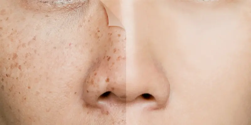 Chữa nám tàn nhang tại spa và viện thẩm mỹ có tốt không? 1 Chữa nám tàn nhang tại spa và viện thẩm mỹ