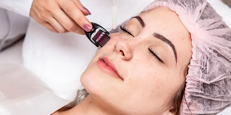 Có nên lăn kim trị nám không?