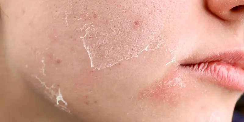 Ưu – Nhược điểm của peel da trị nám