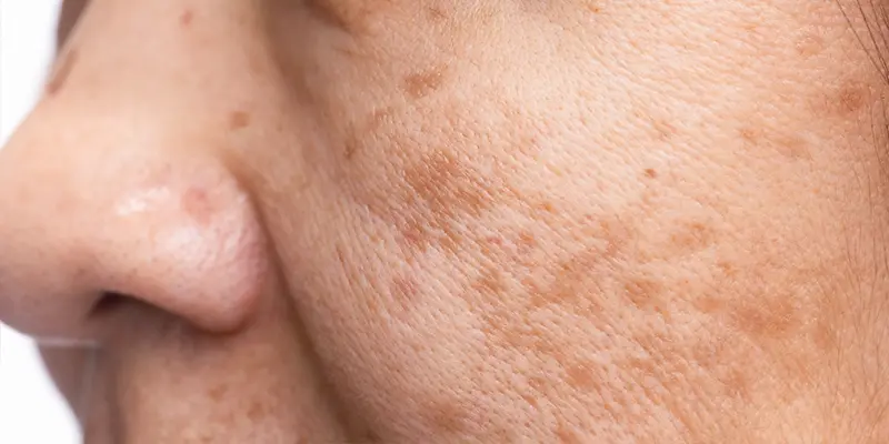 Chữa nám tàn nhang tại spa và viện thẩm mỹ có tốt không? 2 Nám da là gì?