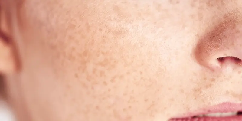 Chữa nám tàn nhang tại spa và viện thẩm mỹ có tốt không? 3 Tàn nhang là gì? Nguyên nhân gây tàn nhang