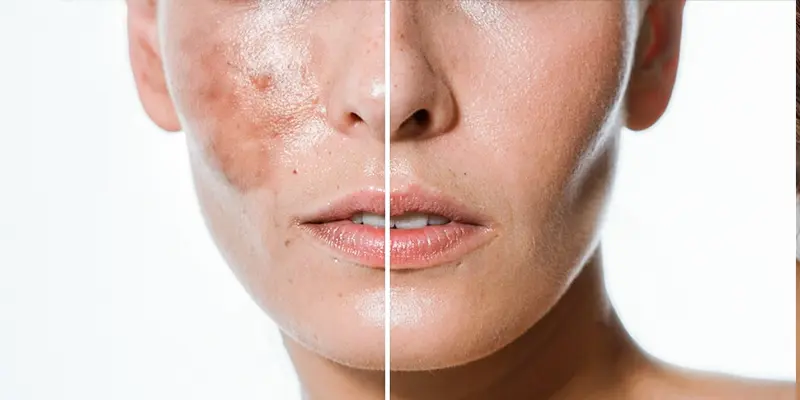5 dấu hiệu bị nám da mặt, không can thiệp sớm sẽ "gây họa" cho da 1 5 dấu hiệu bị nám da mặt