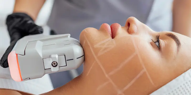 Top 5 Phương Pháp Nâng Cơ Mặt Hiệu Quả Nhất Hiện Nay 2 Nâng cơ mặt bằng công nghệ HIFU