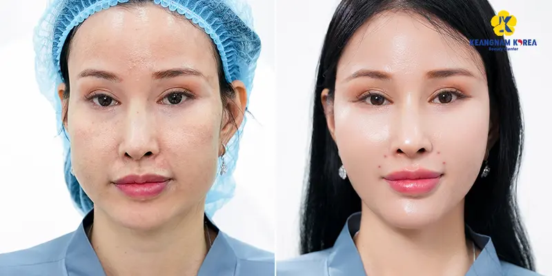 Top 3 Công Nghệ Trẻ Hóa Da Tốt Nhất Hiện Nay 4 Công nghệ trẻ hóa da 1