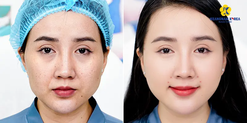 Top 3 Công Nghệ Trẻ Hóa Da Tốt Nhất Hiện Nay 5 Công nghệ trẻ hóa da 2