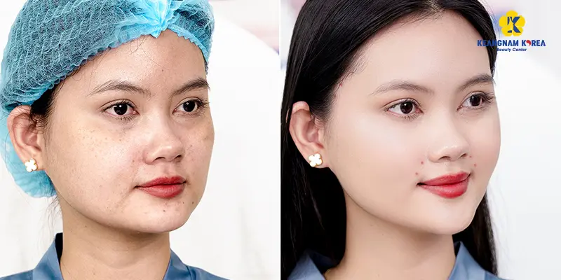 Top 3 Công Nghệ Trẻ Hóa Da Tốt Nhất Hiện Nay 6 Công nghệ trẻ hóa da 3