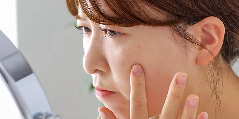 5 dấu hiệu bị nám da mặt, không can thiệp sớm sẽ "gây họa" cho da 2 Nám da là gì? Vì sao cần phát hiện sớm?