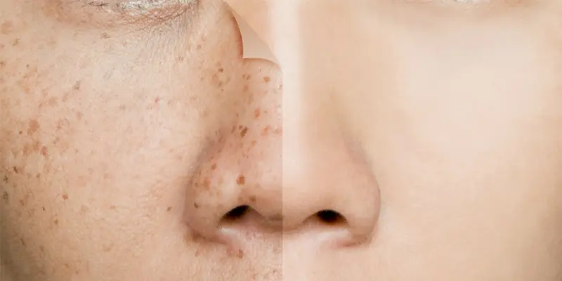 Điều Trị Nám Da Mặt Và Tàn Nhang Ở Đâu Uy Tín? Bí Quyết Lựa Chọn Đúng 1 Điều Trị Nám Da Mặt Và Tàn Nhang Ở Đâu Uy Tín