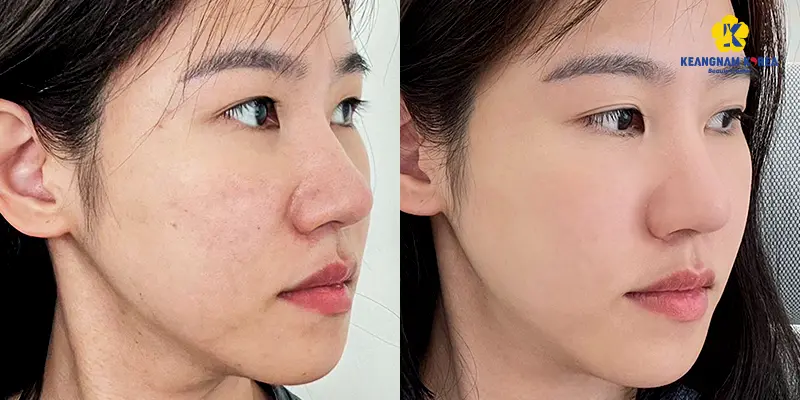Tiêm Meso Exosome là gì? Giải pháp trẻ hóa da được ưa chuộng hiện nay 4 bf af Tiem Meso