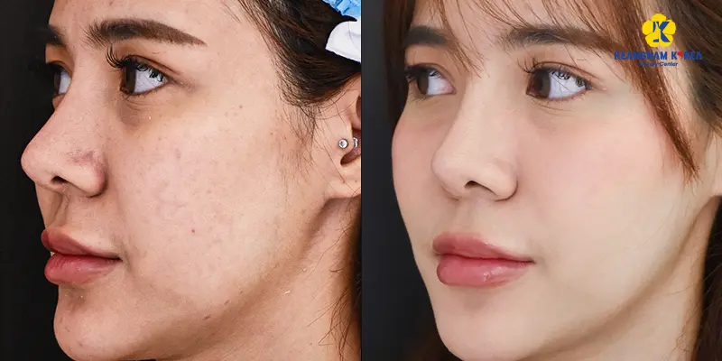Tiêm Meso Exosome là gì? Giải pháp trẻ hóa da được ưa chuộng hiện nay 3 bf af Tiem Meso