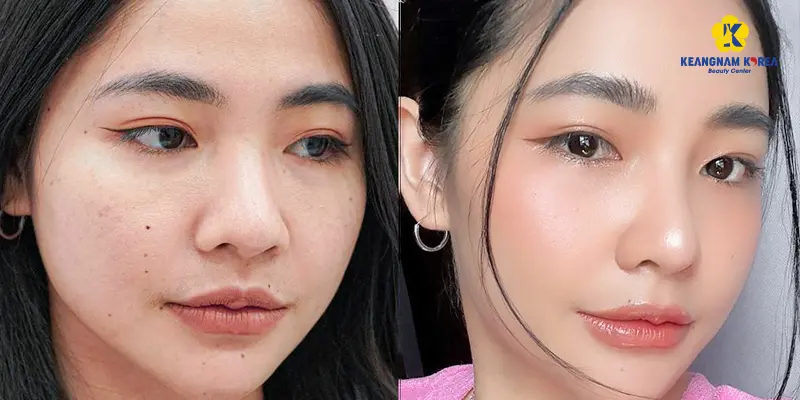 Tiêm trẻ hoá da: 4 liệu trình HOT nhất 2025 4 Lợi ích khi tiêm trẻ hoá da