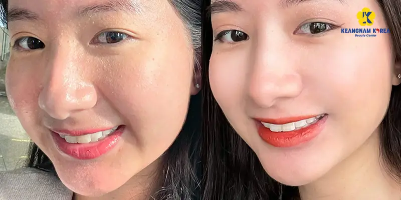 Tiêm trẻ hoá da: 4 liệu trình HOT nhất 2025 6 bf af Tiem tre hoa2