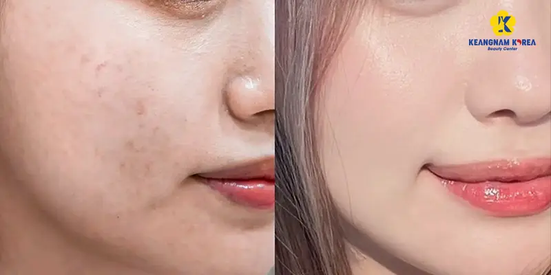 Tiêm trẻ hoá da: 4 liệu trình HOT nhất 2025 5 bf af Tiem tre hoa3