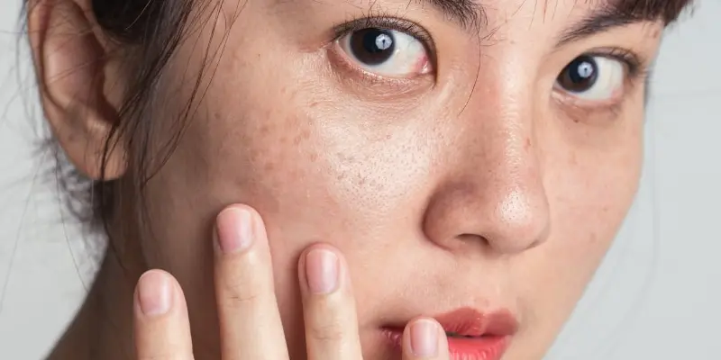 Điều Trị Nám Da Mặt Và Tàn Nhang Ở Đâu Uy Tín? Bí Quyết Lựa Chọn Đúng 2 Vì sao cần điều trị nám da mặt sớm?