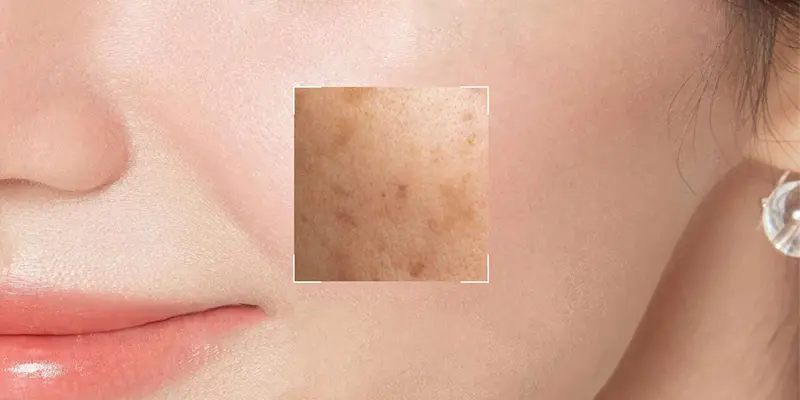 4 Loại Nám Da Phổ Biến – Nguyên Nhân Và Cách Trị Nám Da Mặt Lâu Năm Hiệu Quả 1 4 loại nám da phổ biến và cách trị nám lâu năm