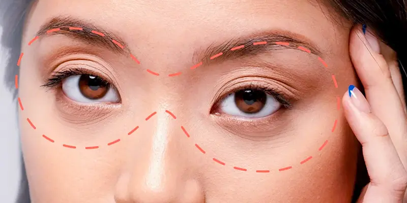 Cấy mỡ làm đầy hốc mắt: Giải pháp cho hốc mắt sâu, duy trì được bao lâu? 1 Cấy mỡ làm đầy hốc mắt