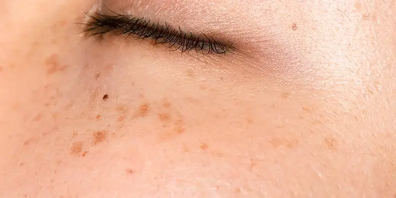 Nám Chân Sâu Là Gì? Nguyên Nhân Và Các Phương Pháp Điều Trị Hiệu Quả 1 Nám chân sâu là gì?