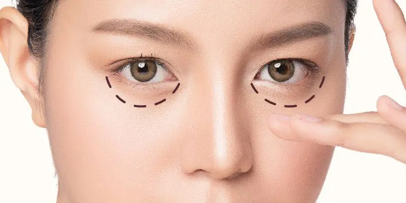 Xóa bọng mắt, trị quầng thâm: Bí quyết lấy lại đôi mắt tươi trẻ 1 Xóa bọng mắt, trị quầng thâm mắt