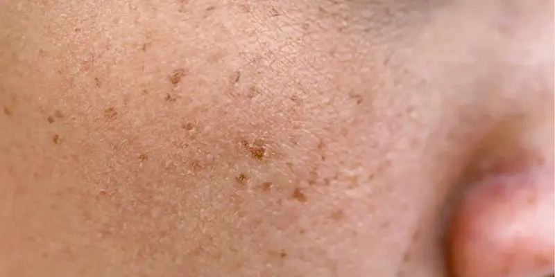 4 Loại Nám Da Phổ Biến – Nguyên Nhân Và Cách Trị Nám Da Mặt Lâu Năm Hiệu Quả 4 Nám chân sâu (nám đốm)