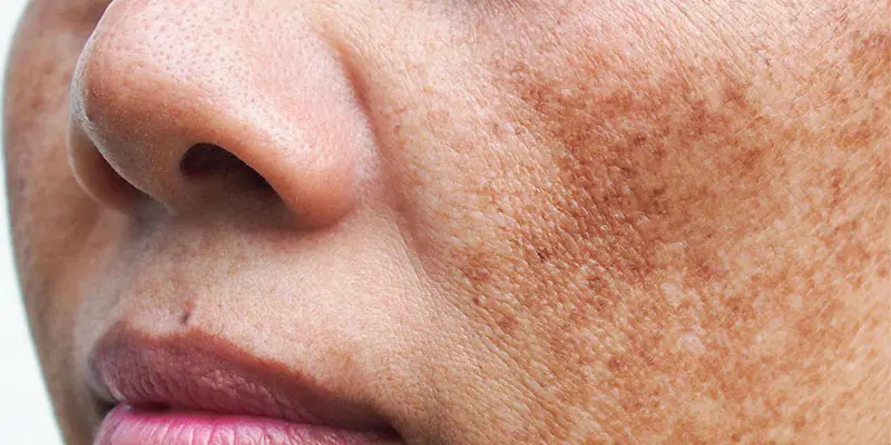 4 Loại Nám Da Phổ Biến – Nguyên Nhân Và Cách Trị Nám Da Mặt Lâu Năm Hiệu Quả 3 Nám mảng (nám nông)