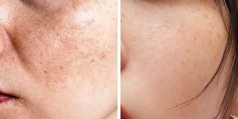 4 Loại Nám Da Phổ Biến – Nguyên Nhân Và Cách Trị Nám Da Mặt Lâu Năm Hiệu Quả 2 Nám da là gì?
