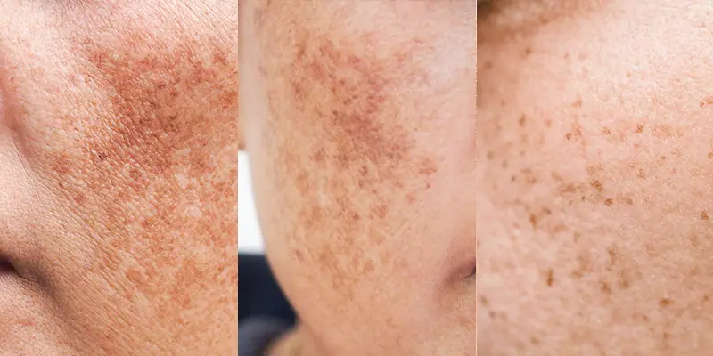 Nám Chân Sâu Là Gì? Nguyên Nhân Và Các Phương Pháp Điều Trị Hiệu Quả 3 Phân biệt nám chân sau và các loại nám khác
