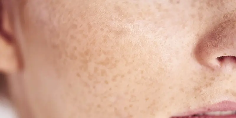 4 Loại Nám Da Phổ Biến – Nguyên Nhân Và Cách Trị Nám Da Mặt Lâu Năm Hiệu Quả 6 Tàn nhang là gì?