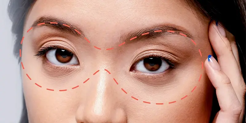 Cấy Mỡ Hốc Mắt Là Gì?